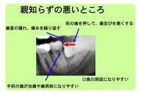 親知らずの話　その2
